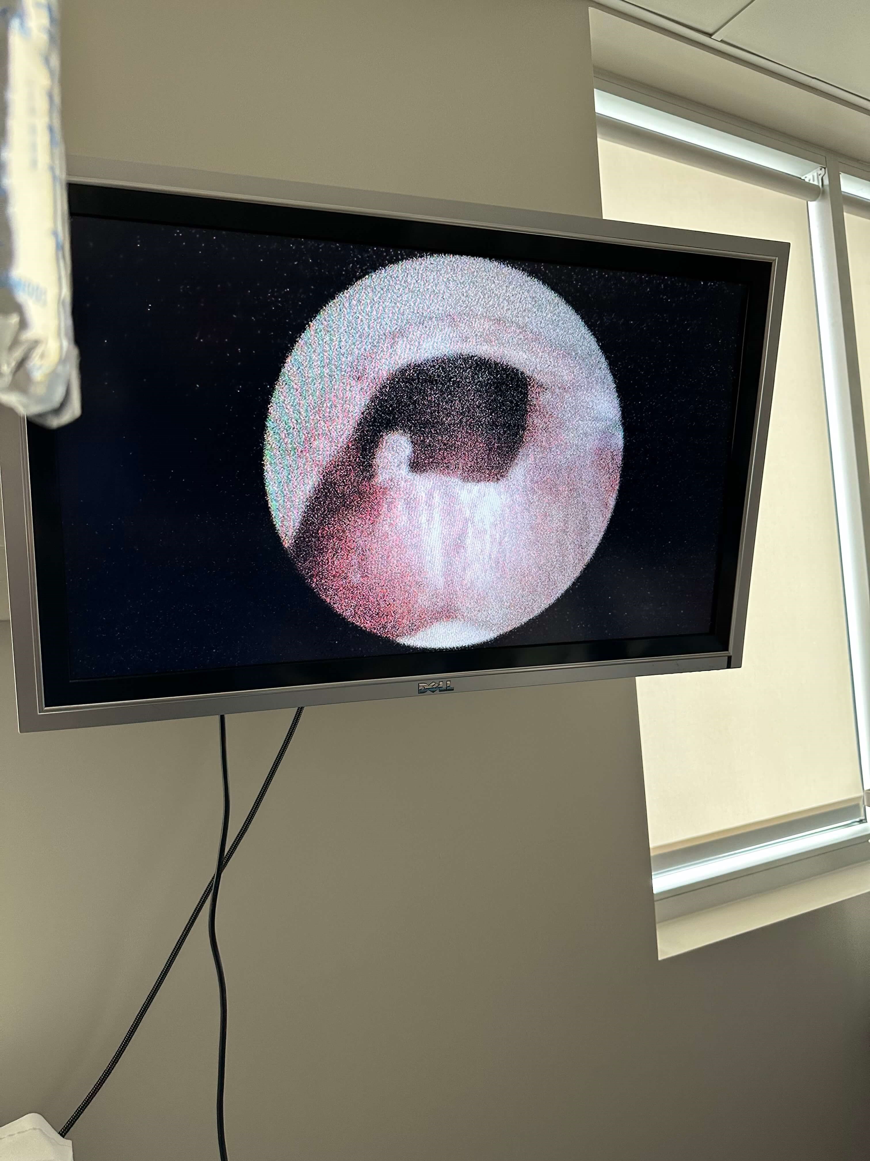 UroLift After UroLift