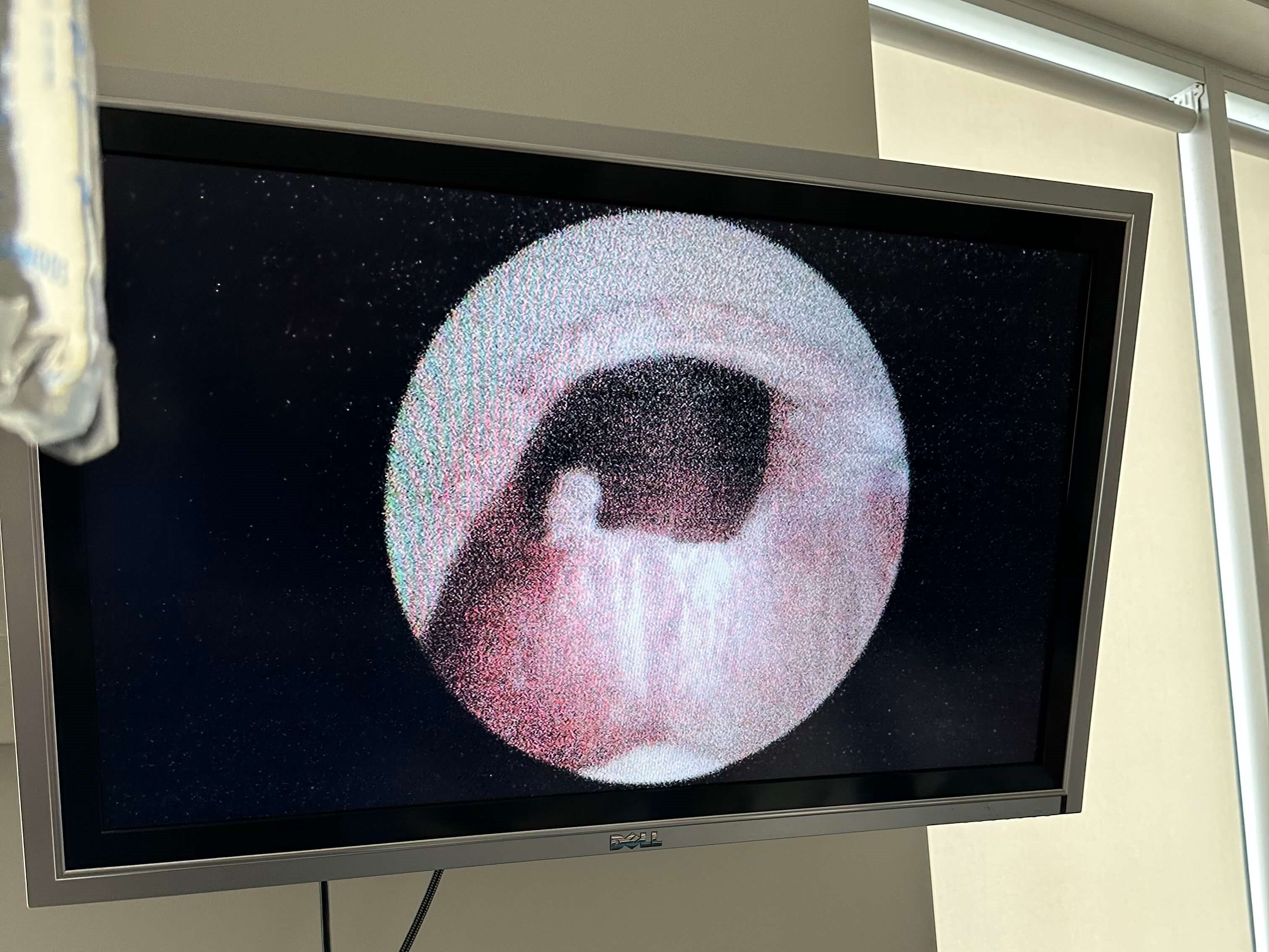 UroLift After UroLift