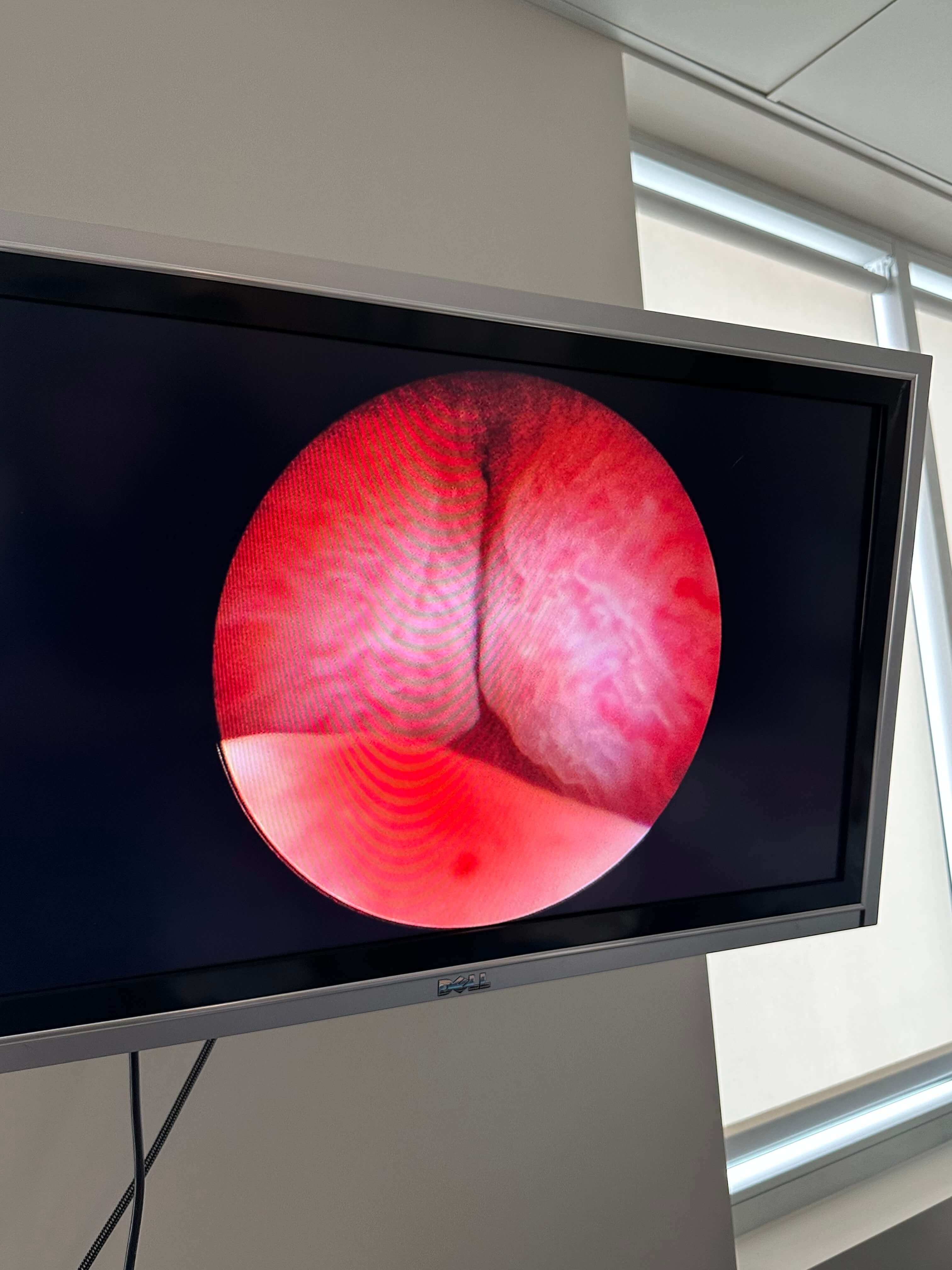 UroLift Before UroLift