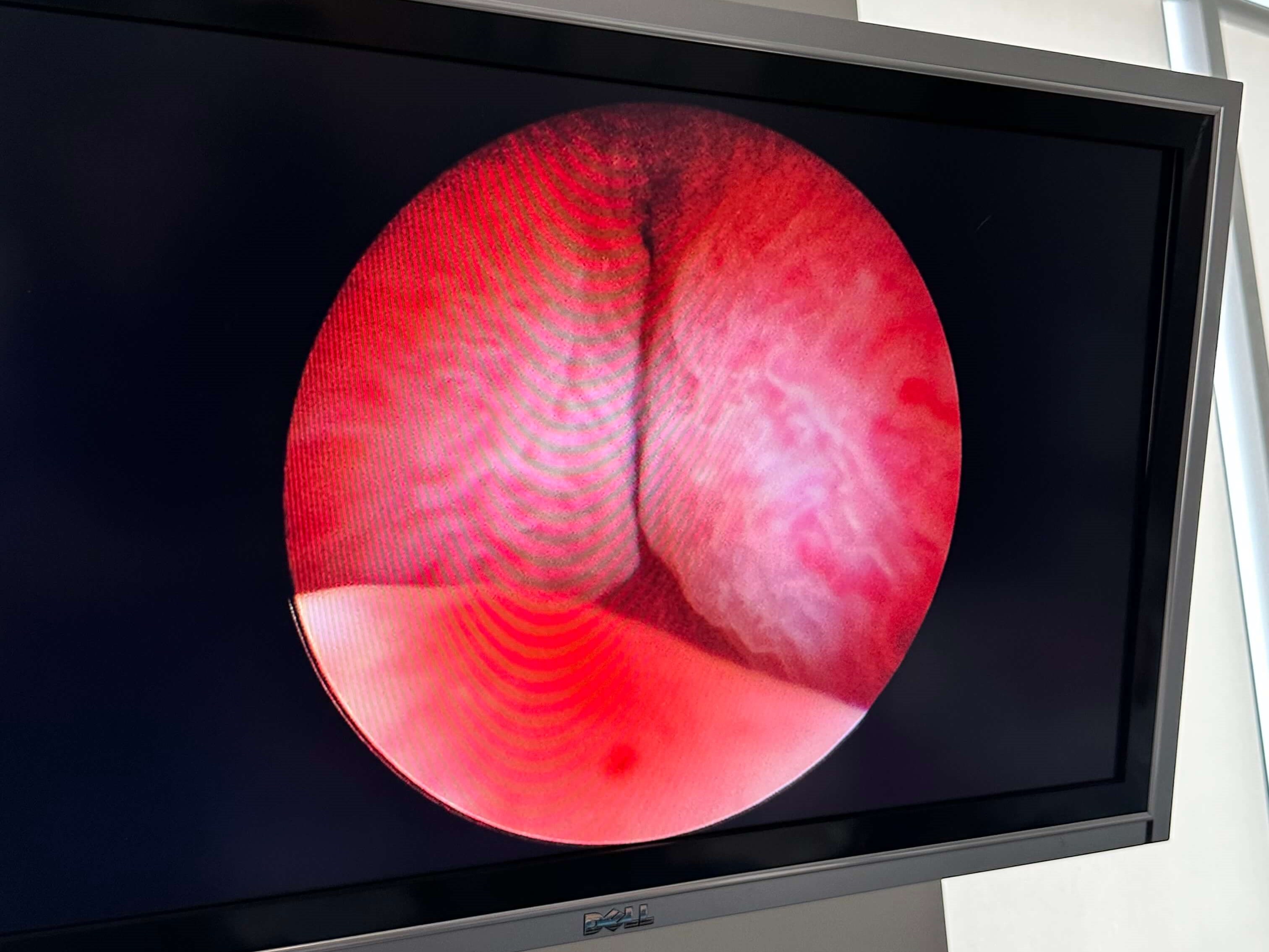 UroLift Before UroLift